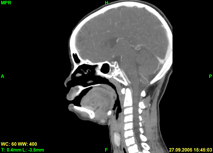 Screenshot of sagittal slice in MPR rendering mode